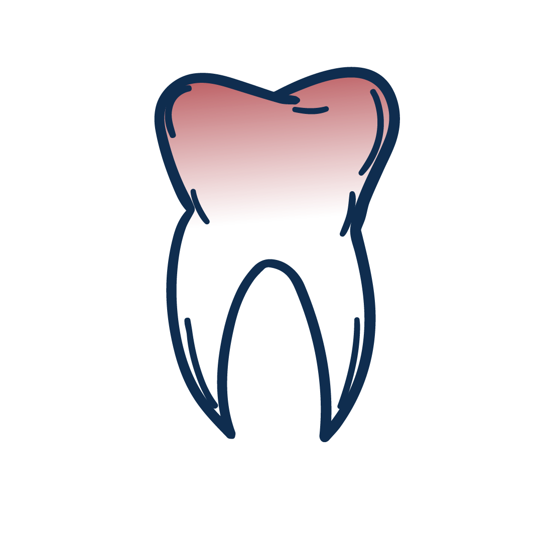 Ricetta 1,2,3 Mal di denti con Alloro nobile, Cannella (corteccia)